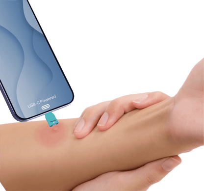 ThermiQ Insect Bite Healer